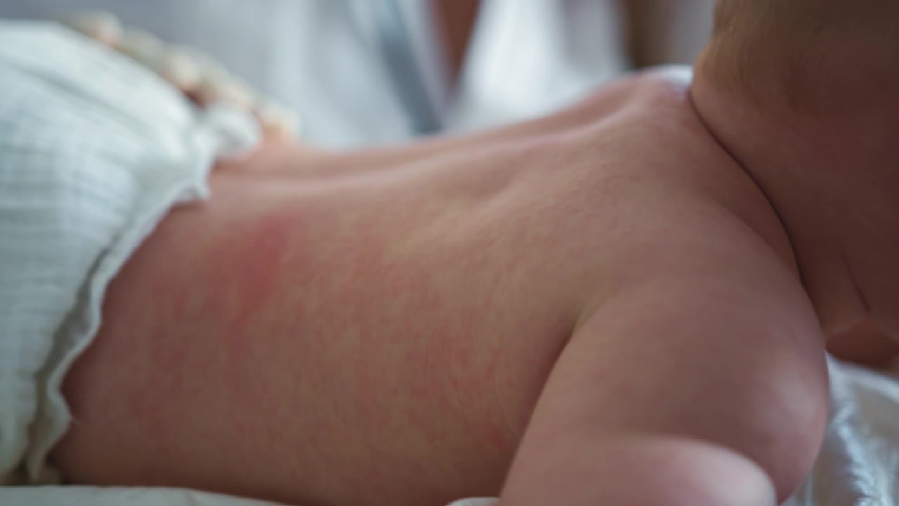 Primo piano della schiena di un bambino che mostra macchie rosse e infiammazione, con una mano guantata che esamina delicatamente.