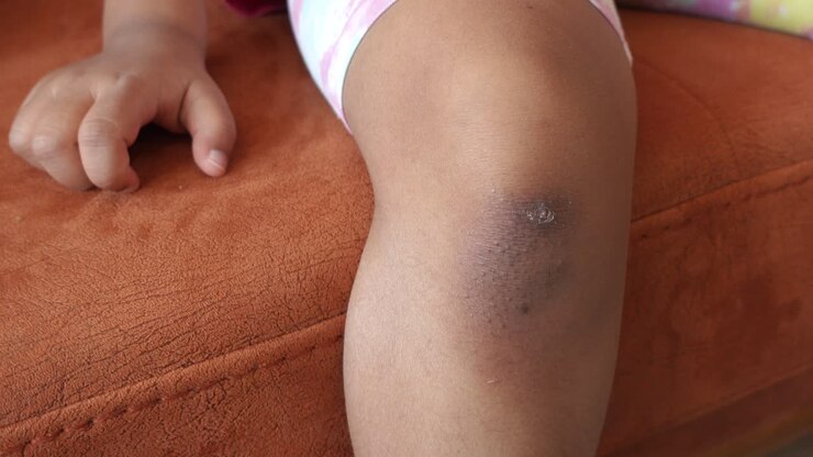 Child with skin rash on knee
