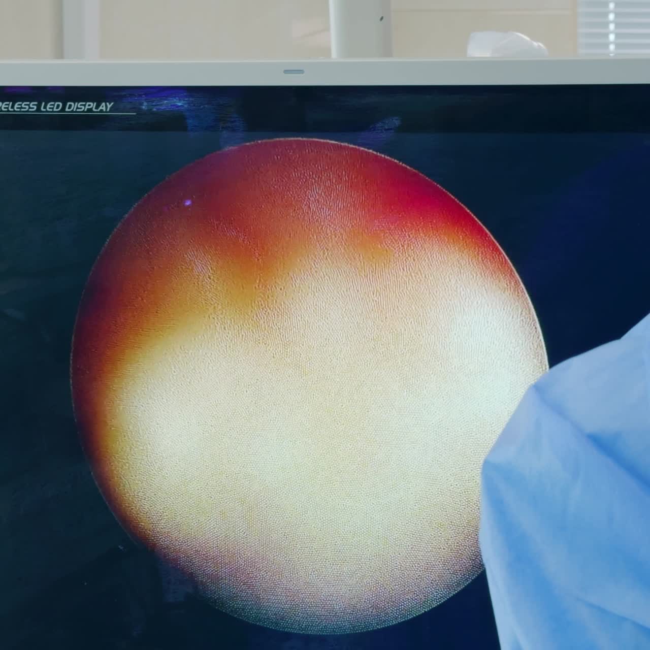 Schermo in sala operatoria che mostra un intervento endoscopico. Primo piano. Attrezzatura per endochirurgia