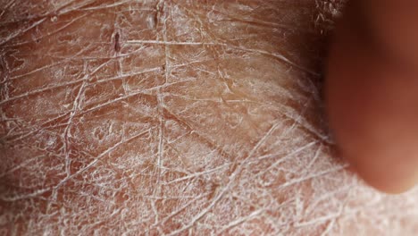 close-up view of severely dry, cracked skin on a hand