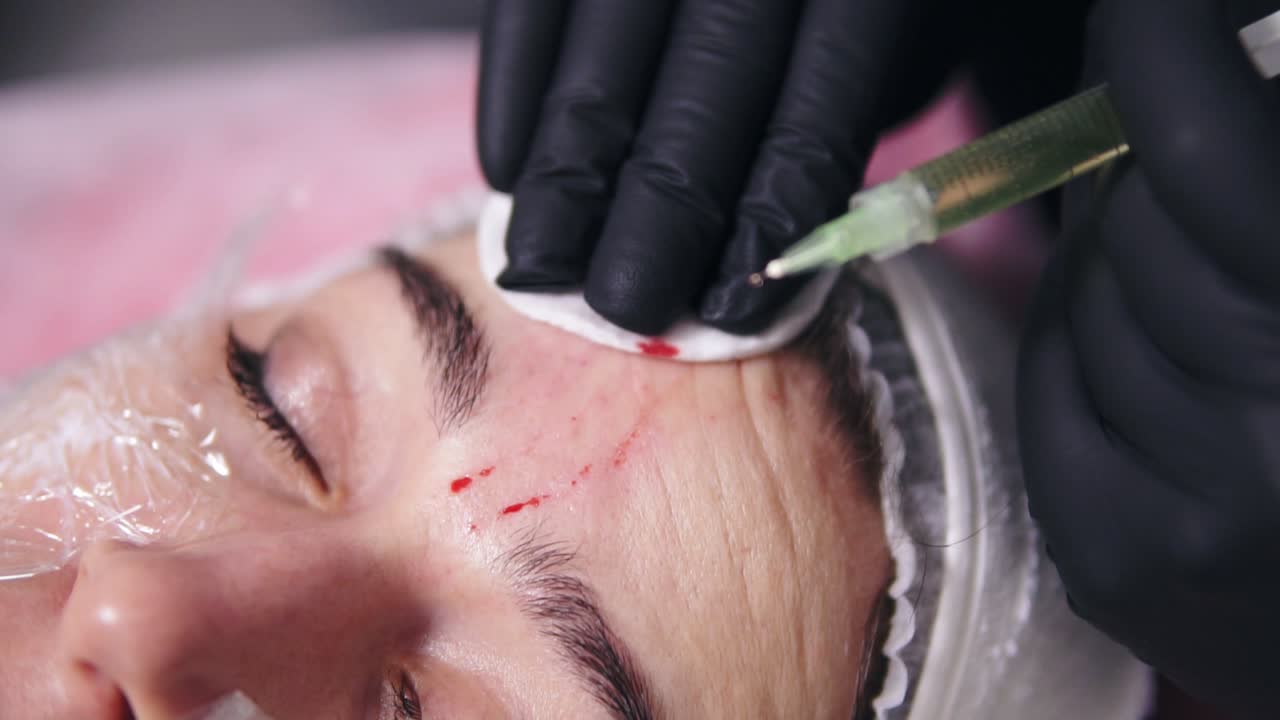 Close Up view of doctor's hands in black gloves making multiple injections in woman's face skin during mesotherapy