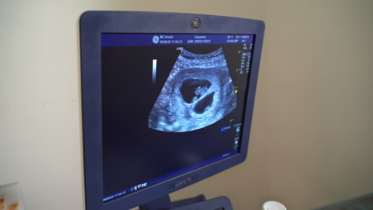 Ultrasound scanning of the human on monitor. Sonography. The screen of the ultrasound machine. Health care concept.