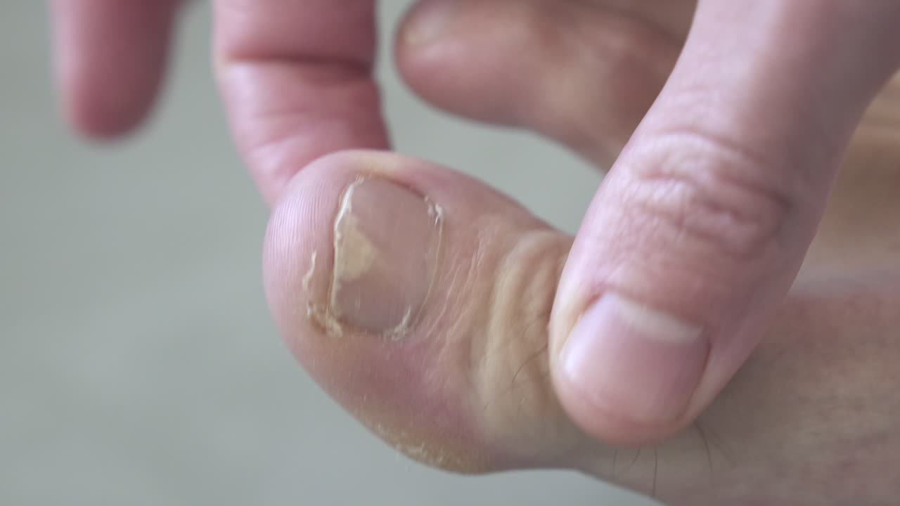 Primo piano dell'alluce di un uomo caucasico bianco con onicomicosi e indurimento della pelle sul lato dell'alluce.