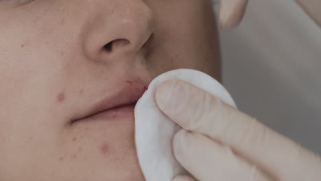 close-up of lip injection cosmetic procedure