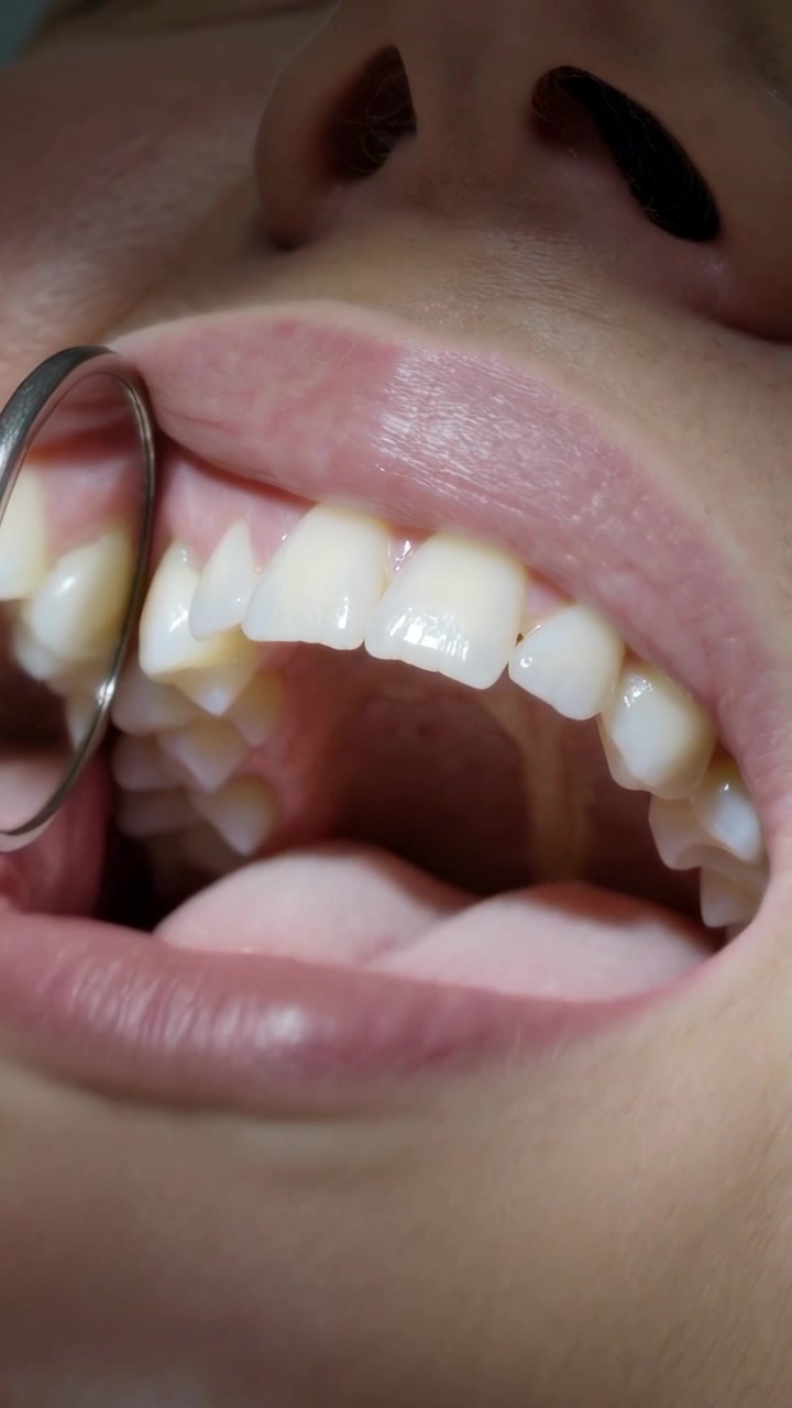 Video verticale: Paziente con la bocca aperta in clinica mentre uno specchietto metallico ispeziona i denti superiori sinistri
