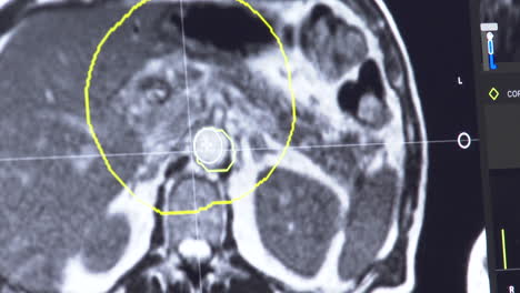 abdominal mri scan with highlighted region