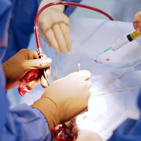 surgical process. hands of a surgeon in sterile gloves performing a surgery on a patient. medical tubes with blood during the operation. close-up.