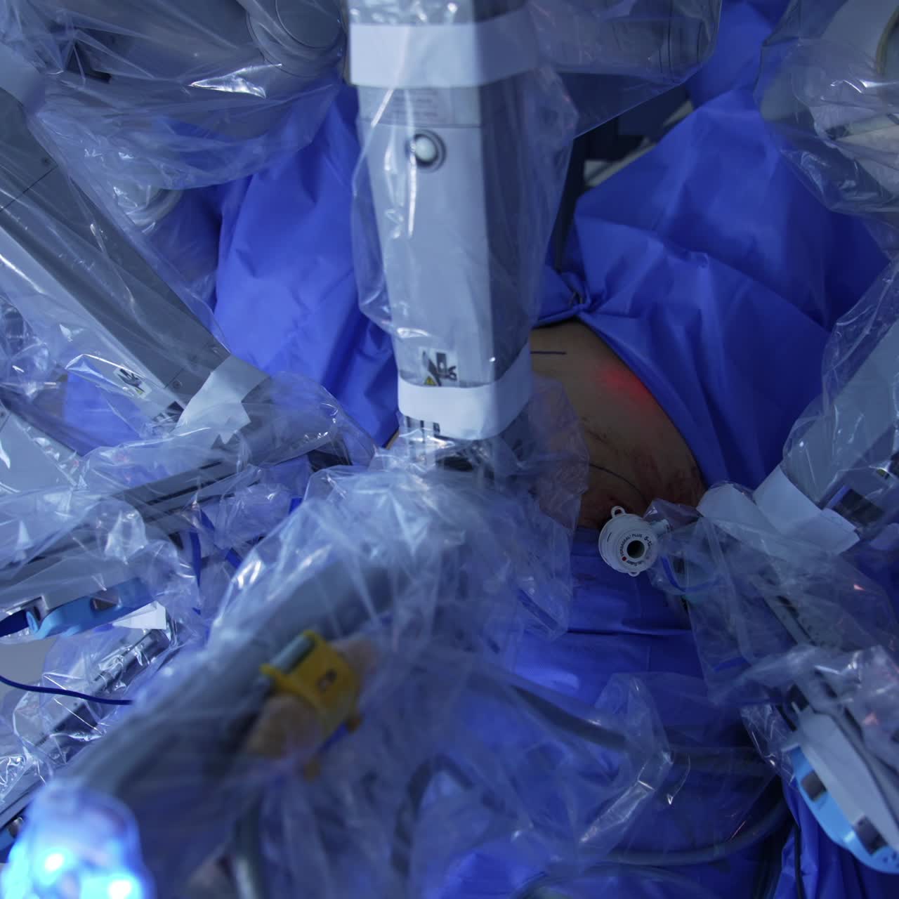 Patient undergoing laparoscopic surgery in modern clinics. Manipulator arms of robotic surgical system moving in the patient's abdomen. Top view