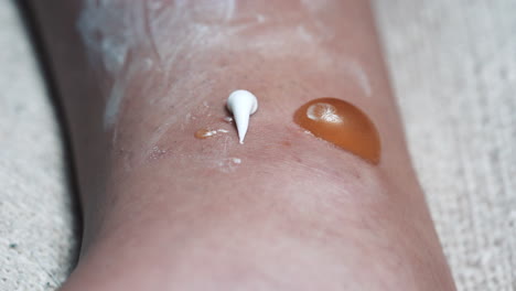 patient applies medical ointment to painful blisters, topical application for treatment of infection