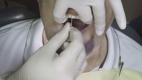 dentist carefully applying a denture for a patient during a dental fitting session