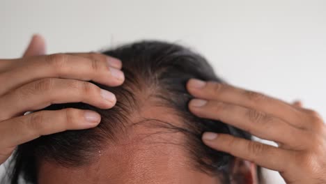 black-haired man with baldness, long hair, minoxidil