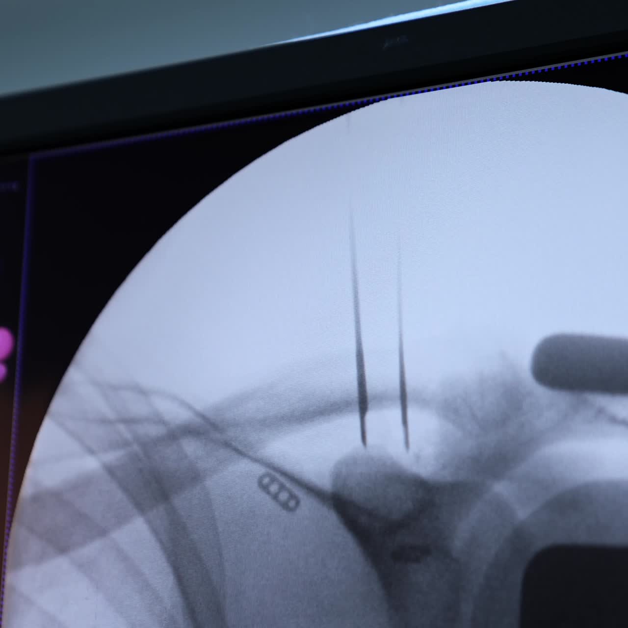 Schermo in bianco e nero con radiografia. Attrezzatura in una sala operatoria moderna. Primo piano