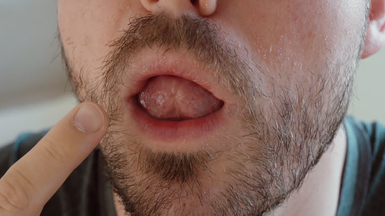 Close-up macro shot of a man's mouth showing a swollen tongue caused by an allergic reaction. Visual representation of allergy symptoms, oral inflammation, and possible medical emergency