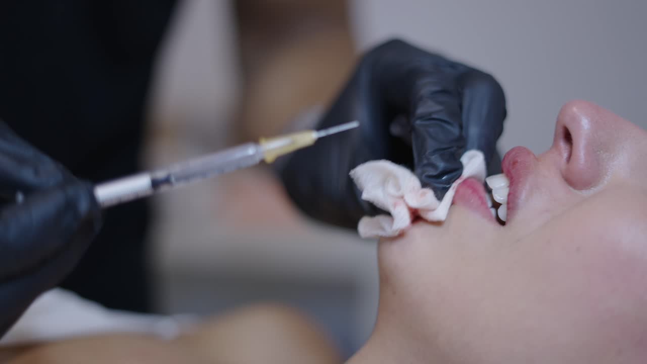 Procedura di iniezione di riempimento delle labbra