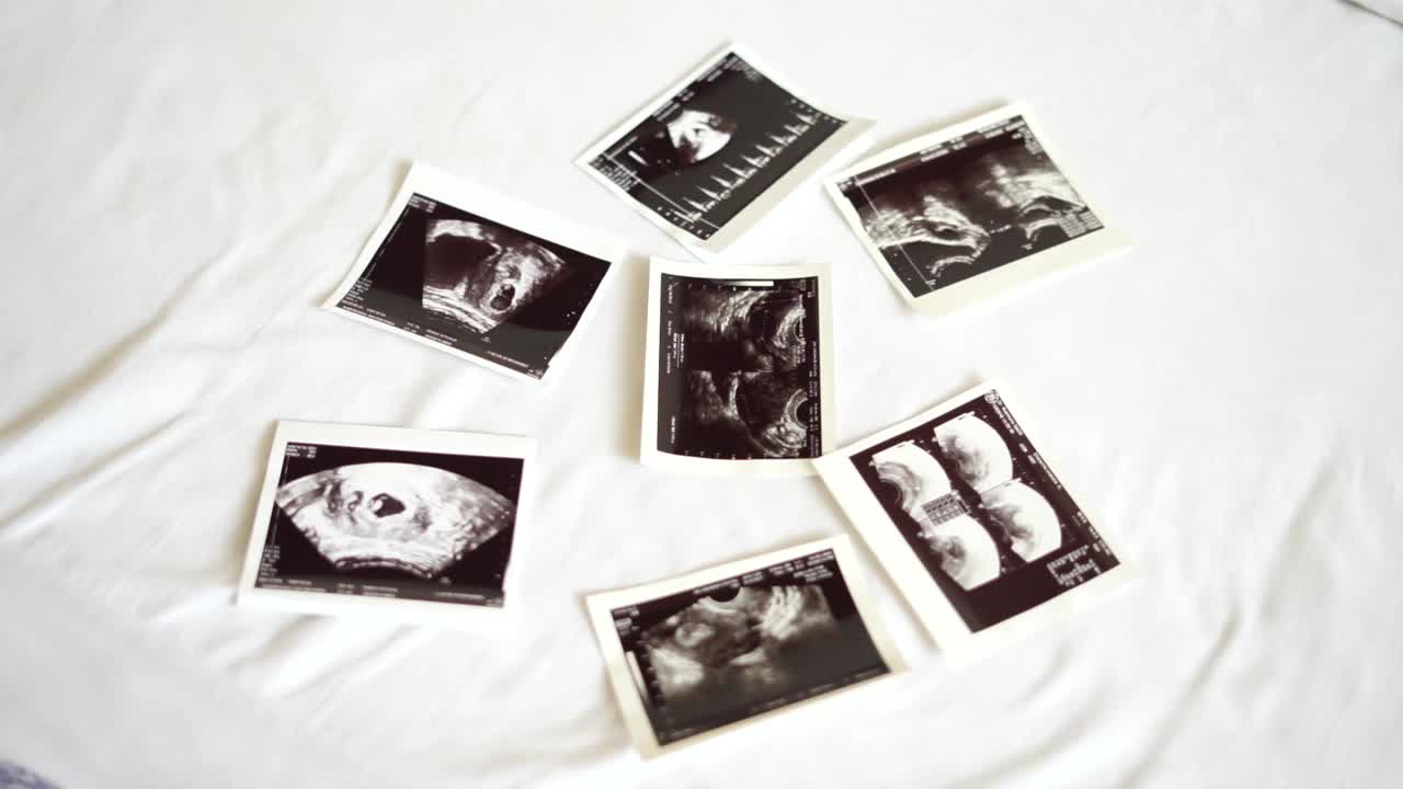 Ultrasound photo on the bed. Concept of waiting for the birth of a baby