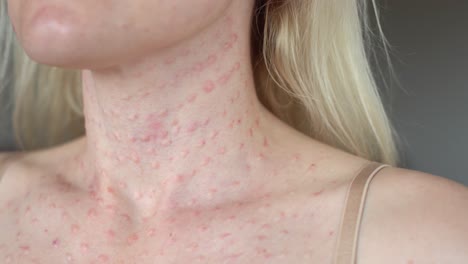 real biorevitalización de la piel en fondo blanco. rastros de inyecciones de biorevitalización en el rostro de la mujer. biorevitalización aguja marcas tratamiento de belleza papulas reales después de la inyección de hialurónico de cerca.
