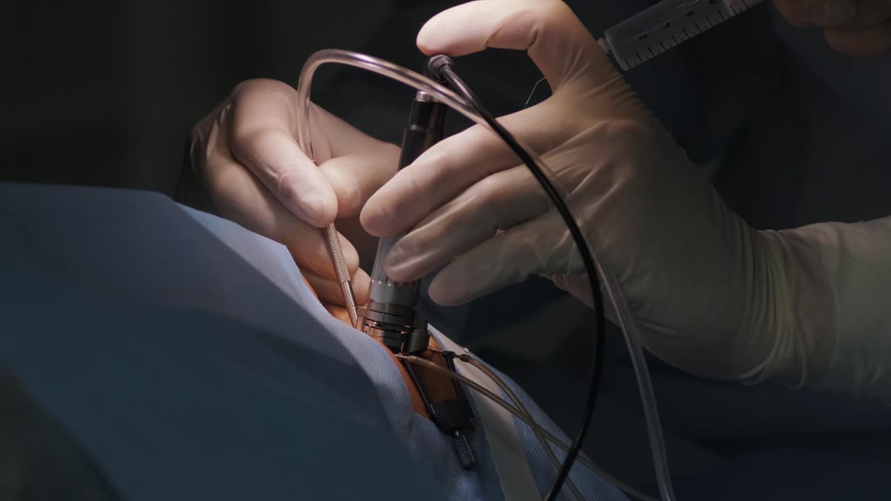 Laser vision correction. A patient and team of surgeons in the operating room during ophthalmic surgery. Eyelid speculum. Lasik treatment. Patient under sterile cover