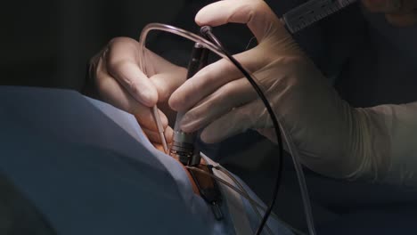 corrección de la visión con láser. un paciente y un equipo de cirujanos en la sala de operaciones durante una cirugía oftalmológica. especulo del párpado. tratamiento de lasik. paciente bajo una cubierta estéril