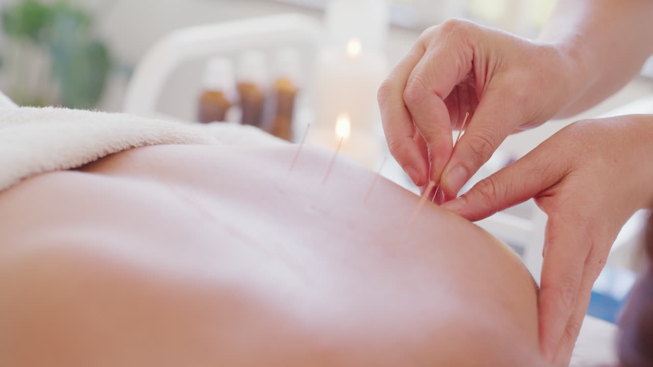 Closeup of acupuncture needles in a patient's