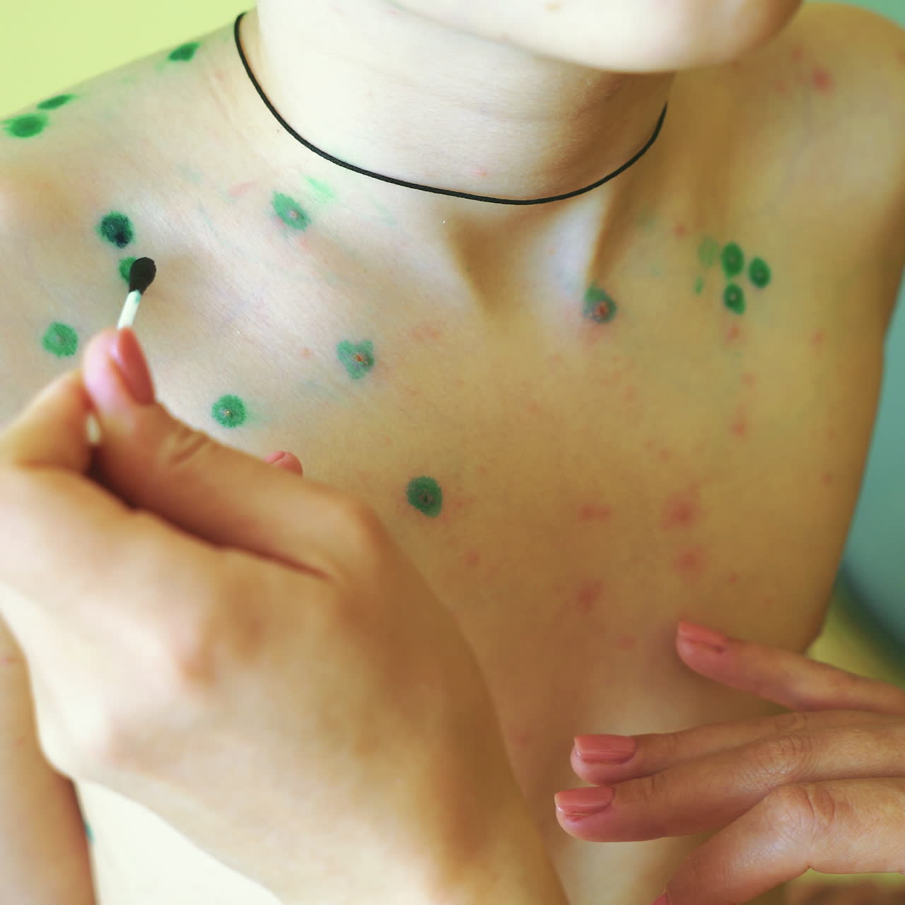 Little boy with chickenpox. Mother applying antiseptic solution to rash. Home treatment. Square video