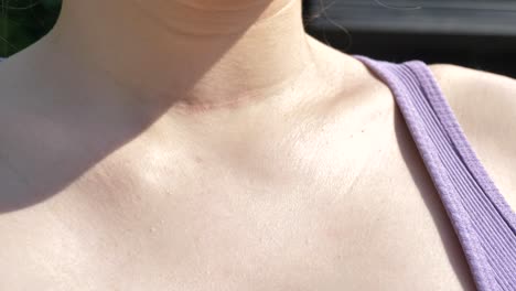 Thyroid-removal-scar-on-caucasian-womans-throat