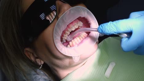 braces removal process