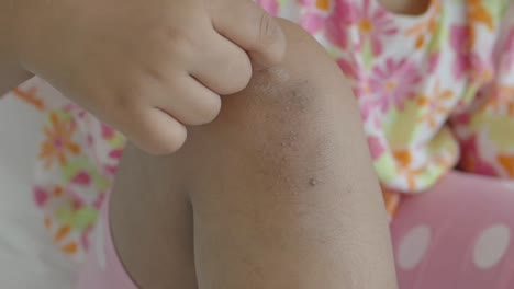 close up of a young girl's knee with a scar