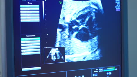blue screen of an ultrasound apparatus showing the abdomen of a pregnant woman. doctor checking the pregnancy condition.