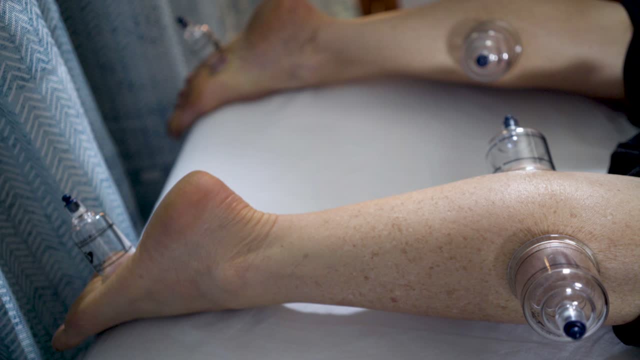 Cupping Therapy on Legs