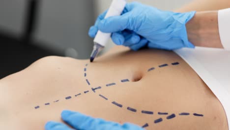 close-up of a patient's abdomen with surgical markings for plastic surgery or liposuction
