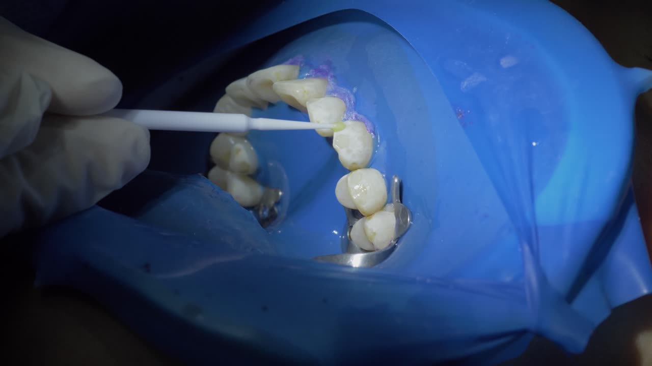 치아 백화 수술의 변형 과정은 전문적으로 청소하는 것과 같습니다.