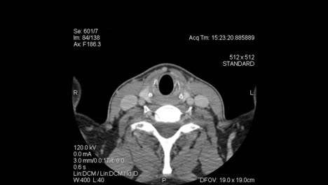 Axial-Tomography:-CT-Scan-layers-from-top-of-head-to-mid-thoracic