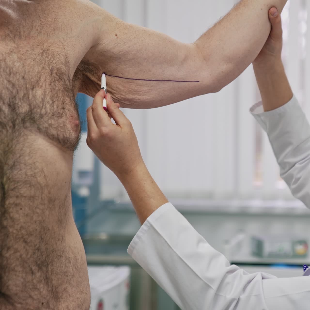 Surgeon paints line on man's body. Plastic doctor doing markup on before plastic operation to remove drooping parts on patient's arm. Correcting body shape
