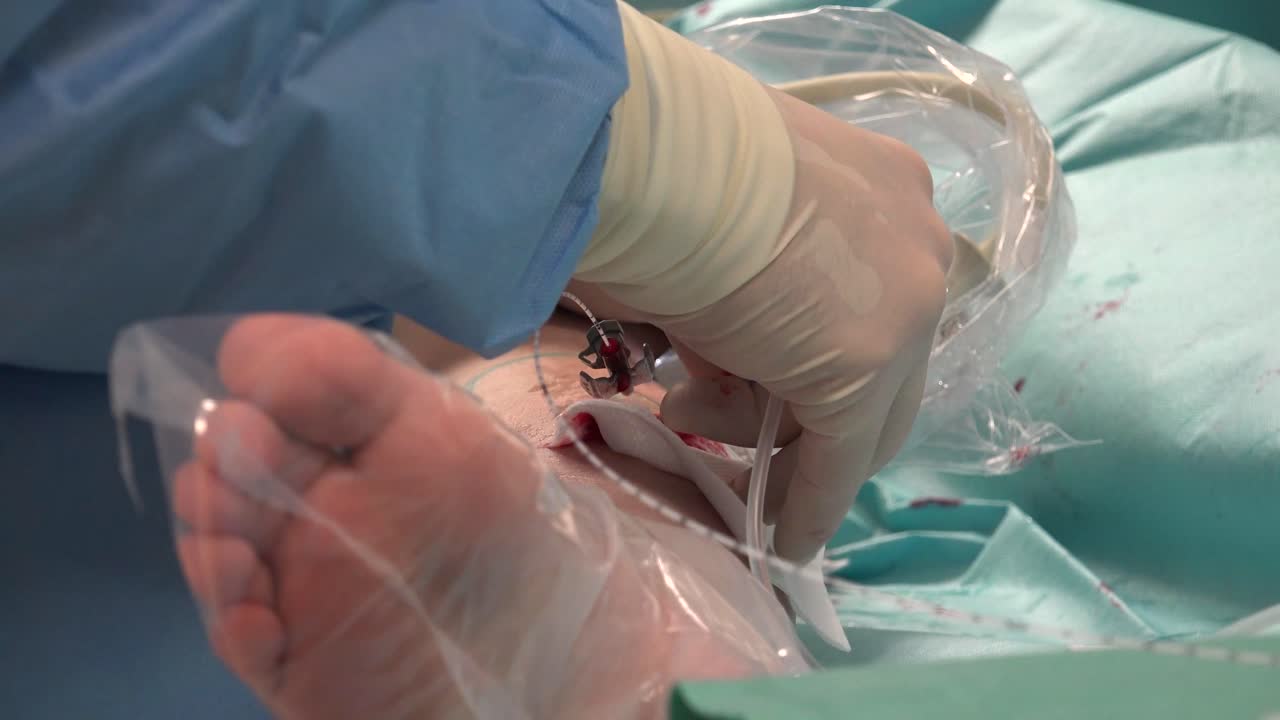 정맥내 레이저 절제는 다리 정맥류를 관리하기 위해 일반적으로 사용되는 매우 효과적인 최소 침습 요법입니다.