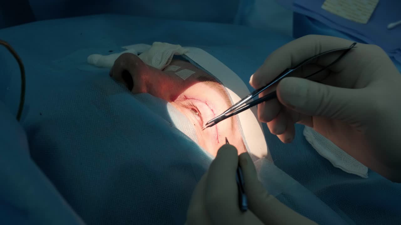 блефаропластика - операция пластической хирургии, омолождение, модификация глазной области.