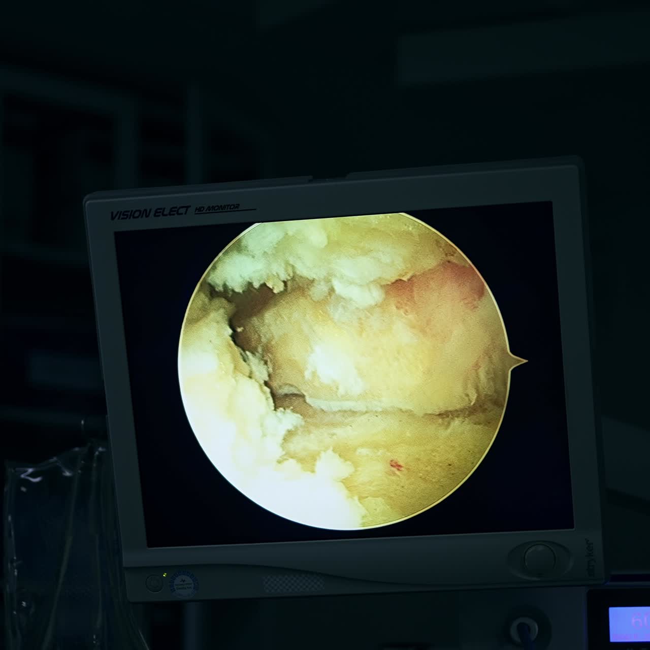 Monitor with the macro picture of inner organ tissue. Screen working in the dark surgery room during operation