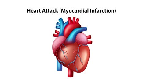 illustration of heart attack progression showing arterial blockage buildup and its impact on heart function