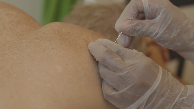 Fysioterapeut udfører dry needling på patients skulder - nærbillede