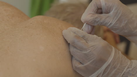 physical therapist dry needling patients shoulder - close