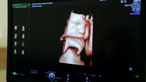 ultrasonido 3d de un feto
