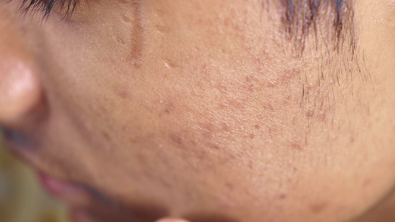 얼굴에 여드름 터와 흔적