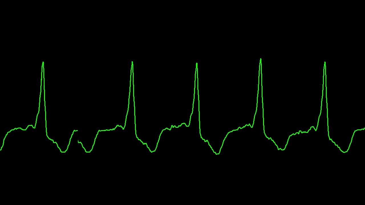 ecg shows wolf parkinsonn white syndrome (WPW)