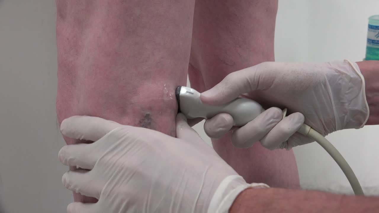 ultrasonografía de venas varicosas de extremidades inferiores