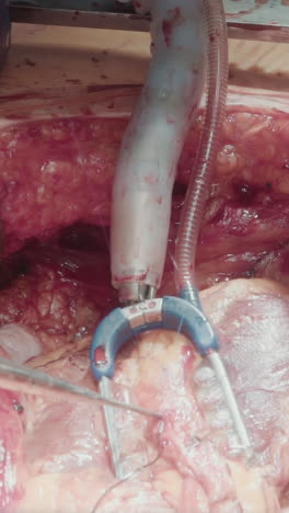 surgeon hands with tools operate patient. procedure to treat coronary artery disease with grafting harvested vessels to divert blood supply closeup
