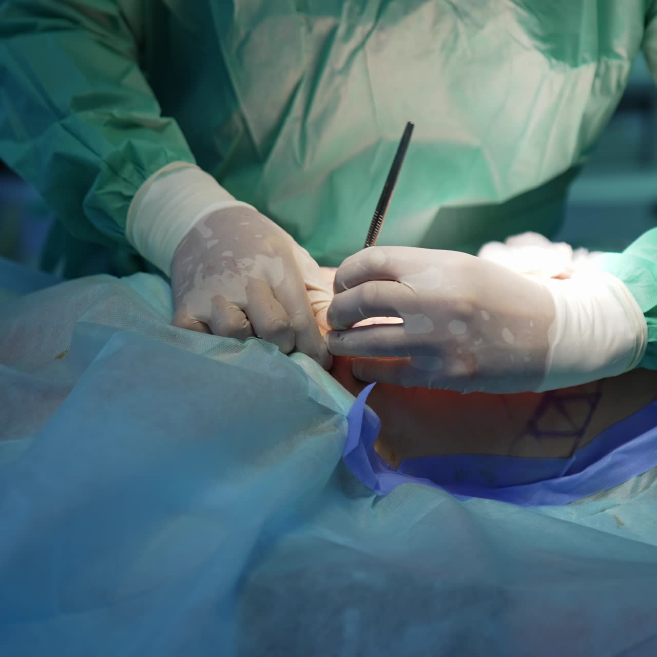 Operative process of patient's belly. Doctor doing surgical procedure to a patient. Liposuction in clinic. Close-up. Health care concept