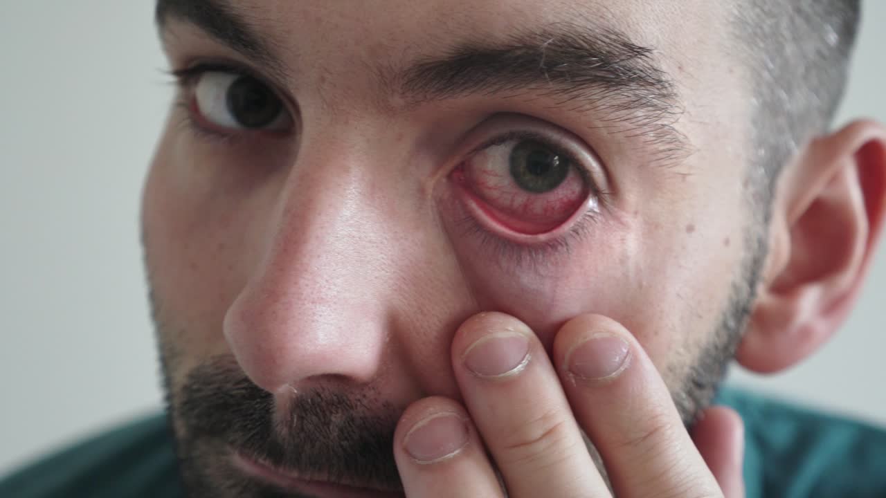 hombre con ojos rojos mirando a la cámara, primer plano