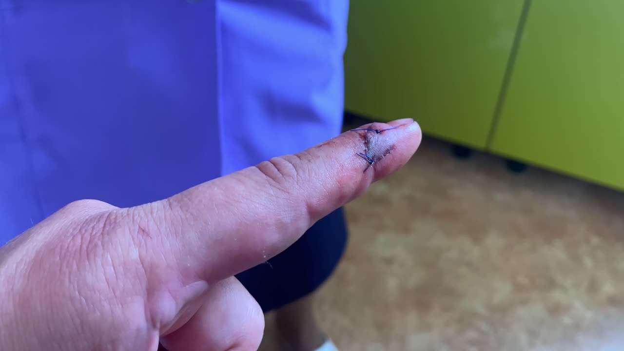 Finger being cleaned and wrapped in bandage at home by nonmedical caregiver, reveal of stitches