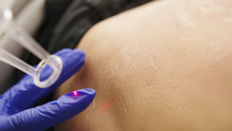 laser skin treatment procedure