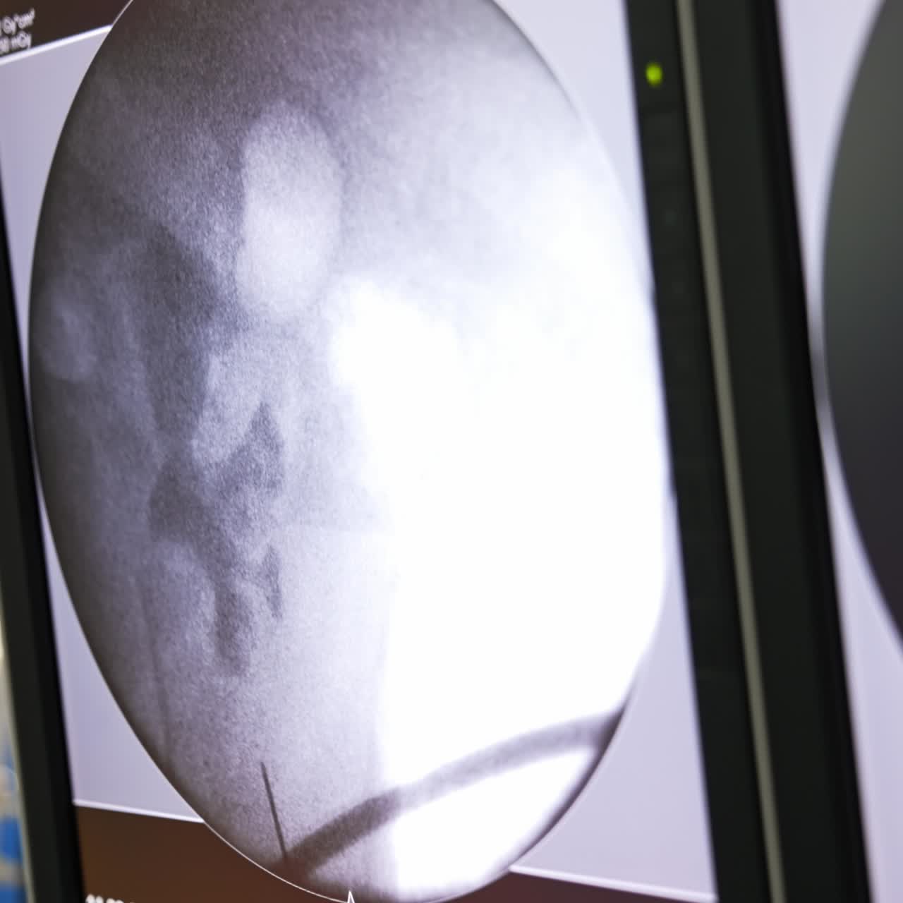 Black-and-white screen showing the ultrasound picture of patient's inner organs. Technologies aiding during the operation. Close up