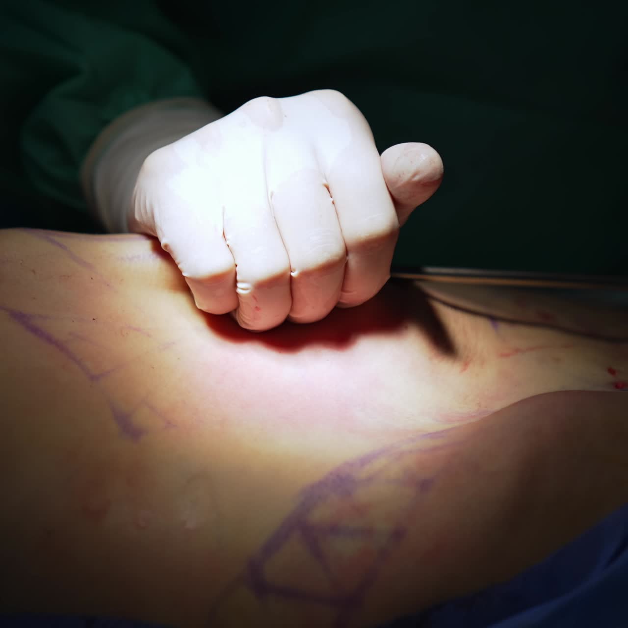 Patient's abdomen during liposuction on the operating table. Surgical procedure for fat removal from patient's belly. Close-up. Light spot of surgical process